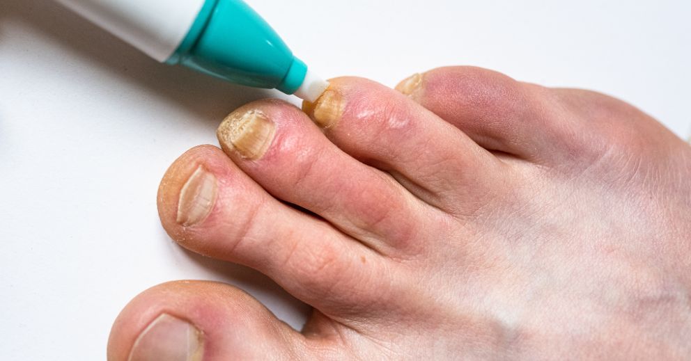 How to Prevent Recurring Fungal Nail Infections
