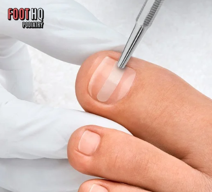 Ingrown Nail Pain? Have You Tried Light-Cured Bracing