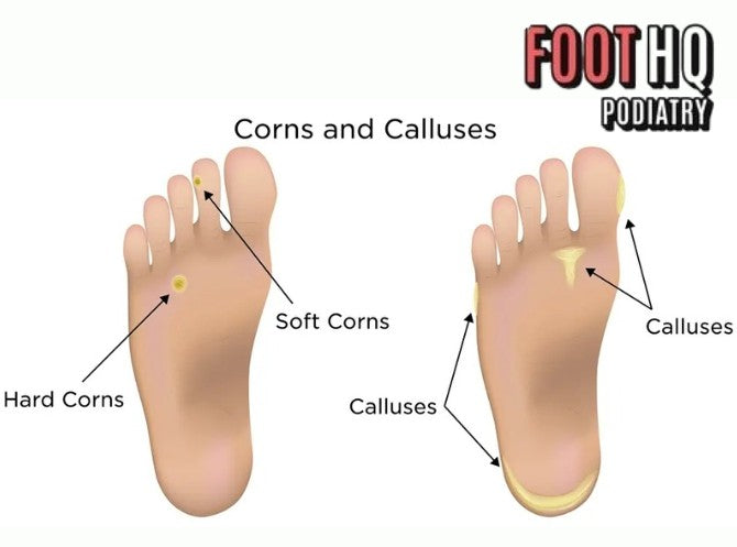 How Do I Treat Corns and Calluses Effectively?