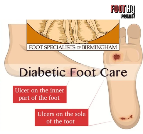 Is My Foot Pain Related to Diabetes?