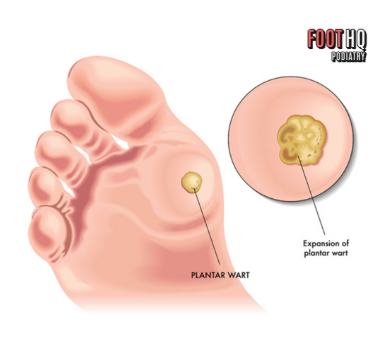 Should I Be Concerned About a Lump or Bump on My Foot?