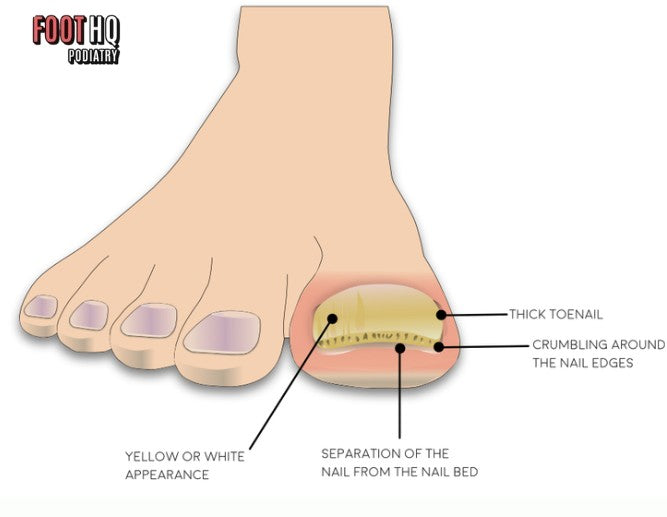 Are My Toenails Thick Because of Fungus or Something Else?