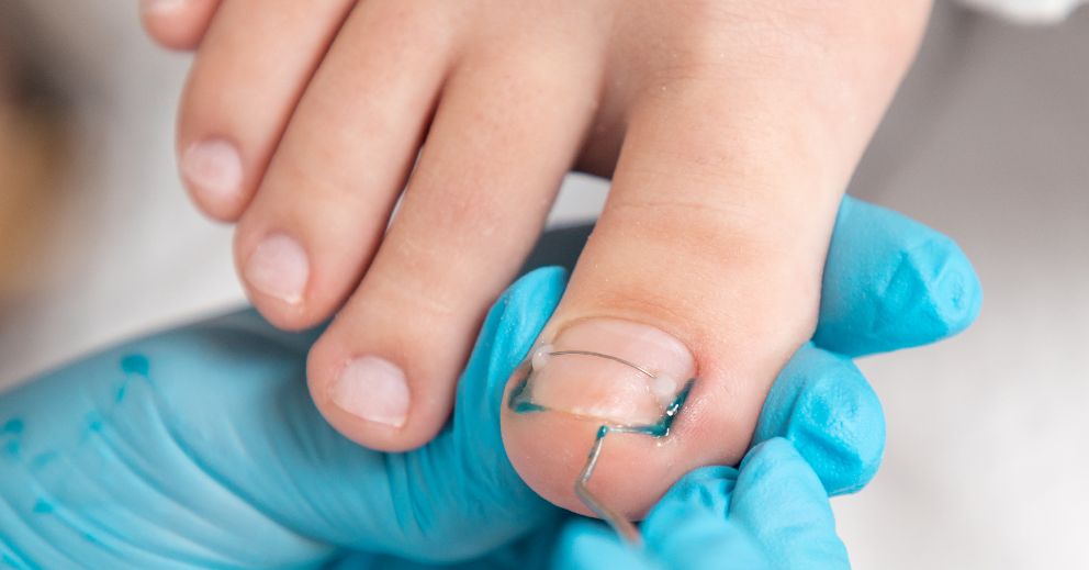 Early Signs of an Ingrown Toenail: Don’t Wait Until It’s Infected