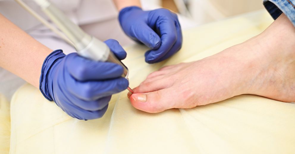 Laser Therapy for Fungal Nails: Is It Worth It?