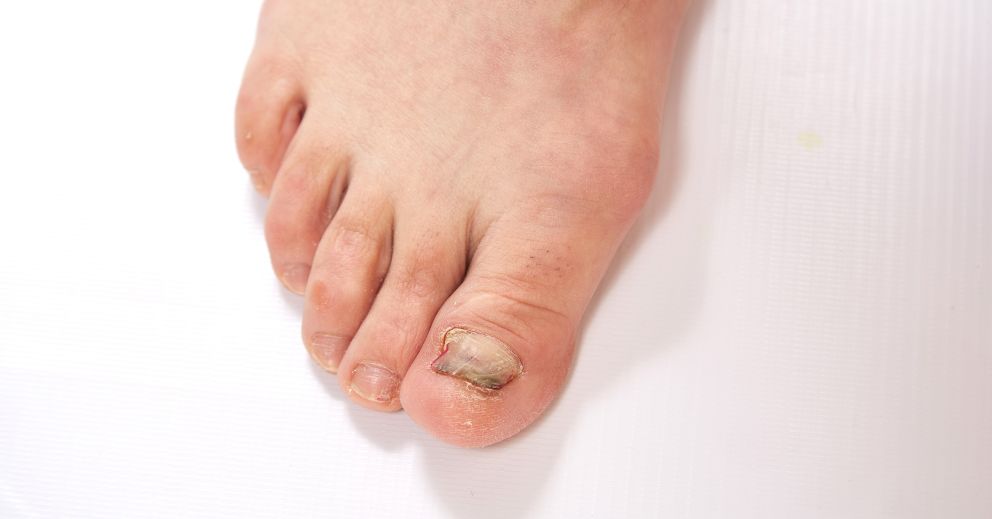 Why Your Fungal Nail Treatment Isn't Working