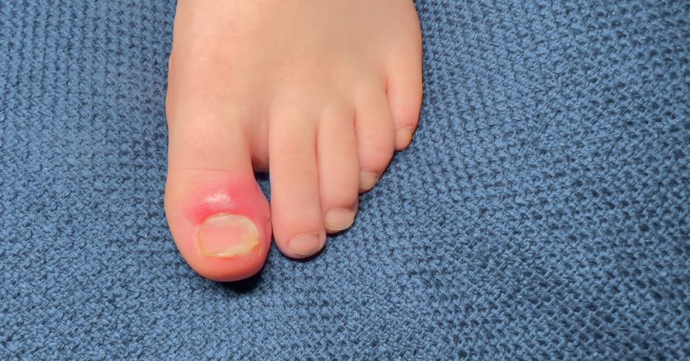 What Causes Ingrown Toenails to Keep Coming Back?
