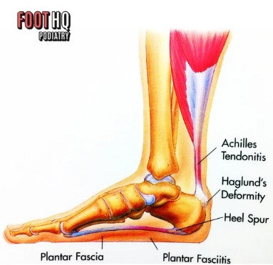 How Do I Treat Heel Spurs or Achilles Tendonitis?