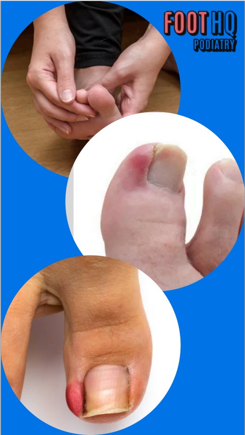 Why Do I Keep Getting Ingrown Toenails, and How Can They Be Treated or Prevented?