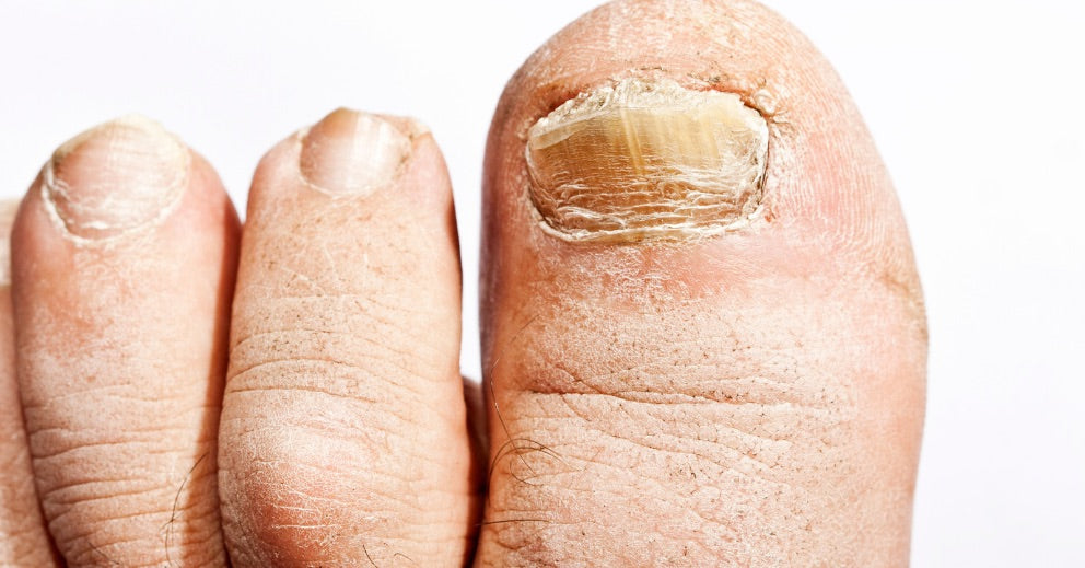 Is Toenail Fungus Contagious? What You Should Know