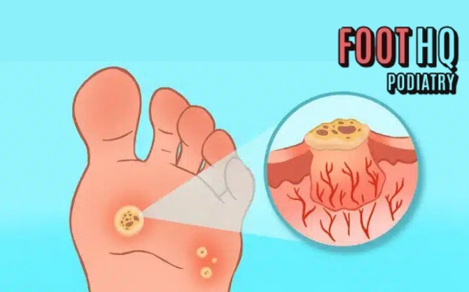 What can I do for plantar warts?
