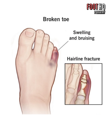 What Should I Do If I Suspect a Broken Toe or Foot Bone?