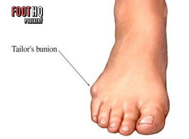 Why Do I Always Get a Painful Lump on the Side of My Foot?