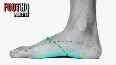 Why Do I Get Sharp Pain in My Arch When Walking or Running?