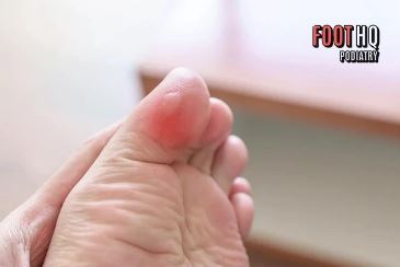 Why Do I Keep Getting Blisters on the Same Spot of My Foot?