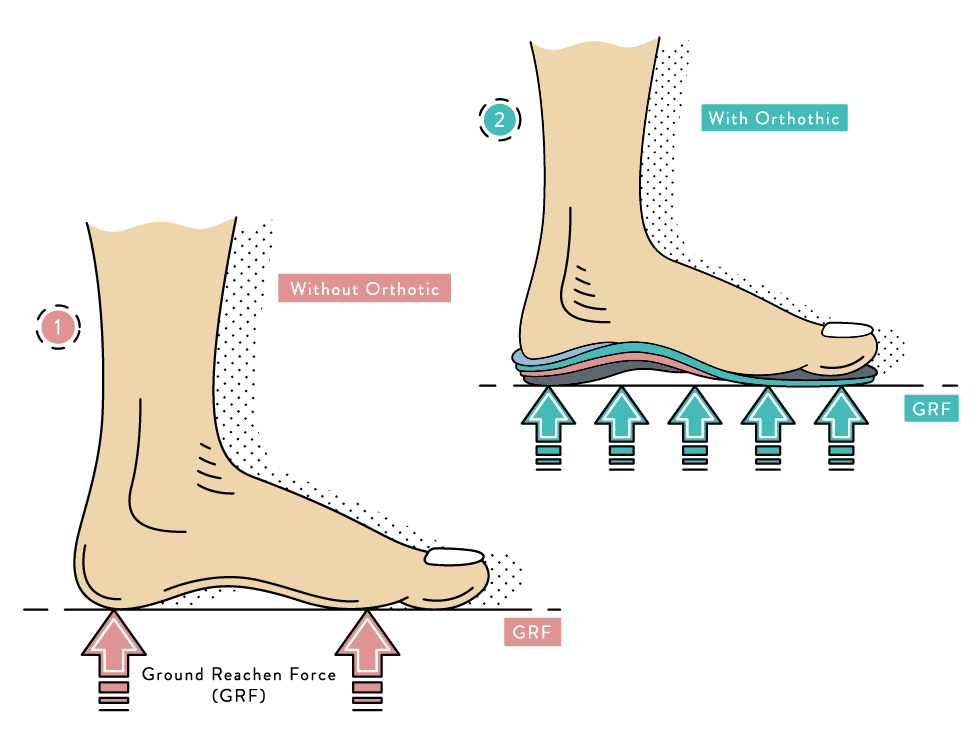Can Orthotics Help My Foot Pain or Do I Need Custom Ones?