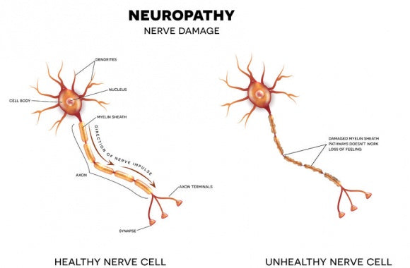 Peripheral Neuropathy - What you NEED to know!
