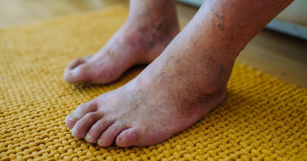Why Diabetics Should Never Ignore Minor Foot Injuries
