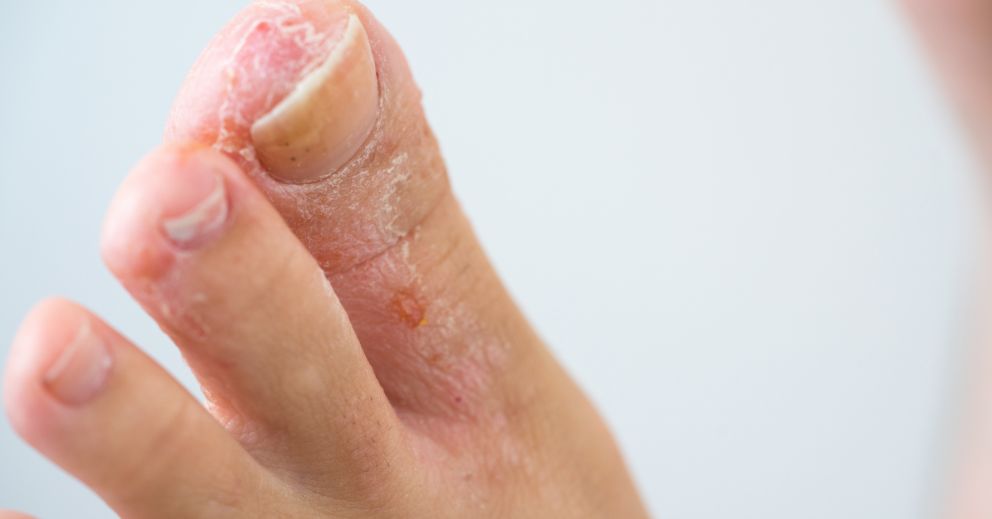 What Causes Dry, Peeling Skin on Feet?