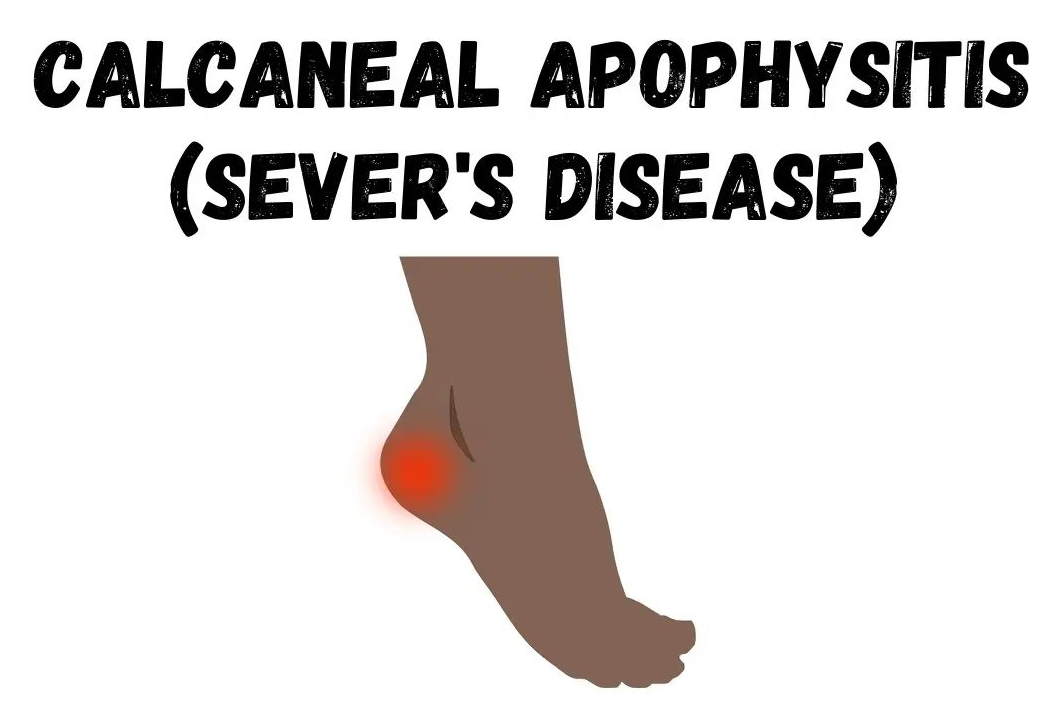 sever's disease - calcaneal apophysitis