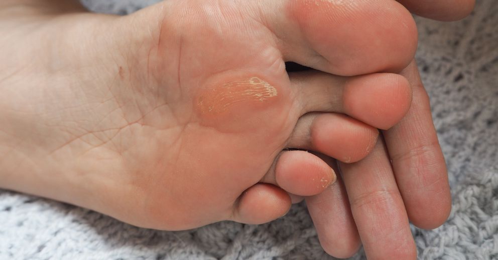 Corns vs Calluses: What’s the Difference and Why It Matters