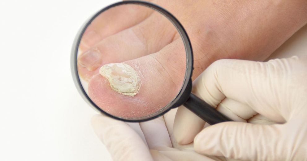Fungal Toenails in Adults: Understanding Symptoms, Causes and Effective Treatment Options