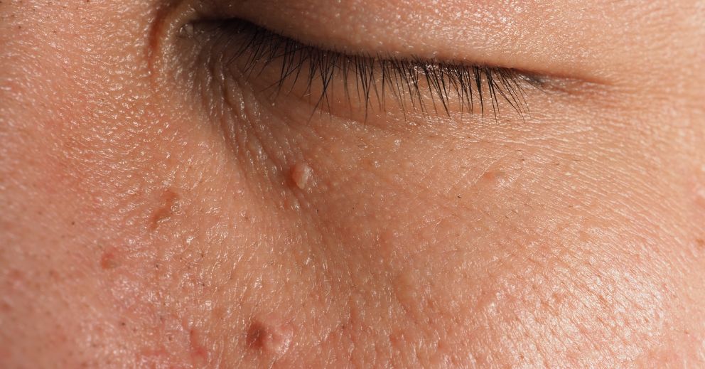 Laser vs Traditional Wart Removal: Which Is Better?