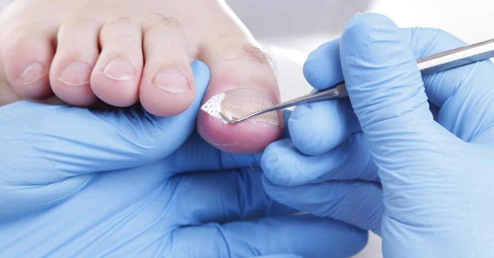 Ingrown Toenail Treatment Options: From Conservative to Minor Surgery