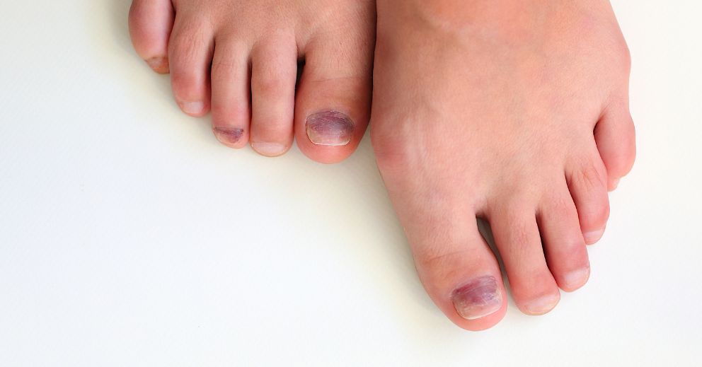Can Toenail Trauma Lead to Fungus? What You Should Know