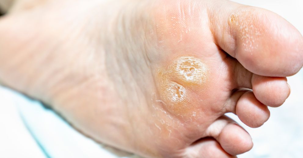 Why Corns and Hard Skin Keep Coming Back and How to Fix It