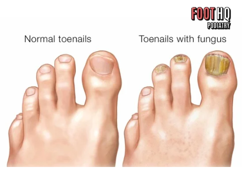 Can You Help with Toenail Fungus?