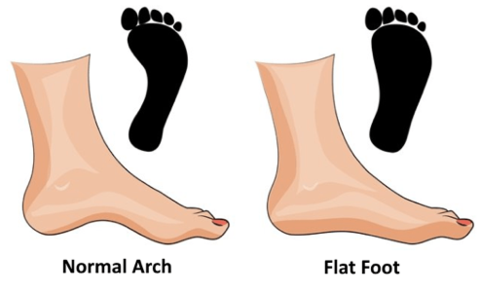 Flat Feet Phenomenon
